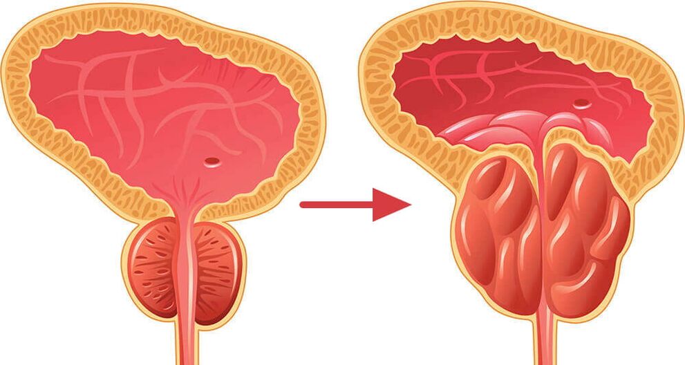 Prostata – normal und entzündet