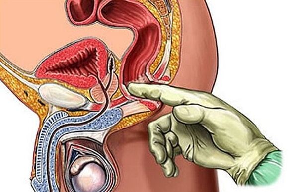 Prostatamassage zur Behandlung von Prostatitis