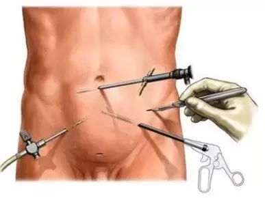 chirurgische Behandlung chronischer Prostatitis