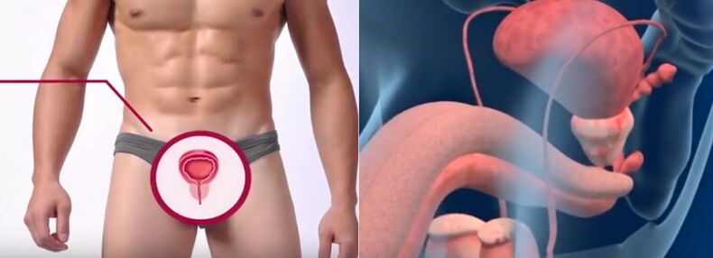 Prostatitis bei Männern, erkennbar an bestimmten Anzeichen